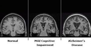 fmridementia